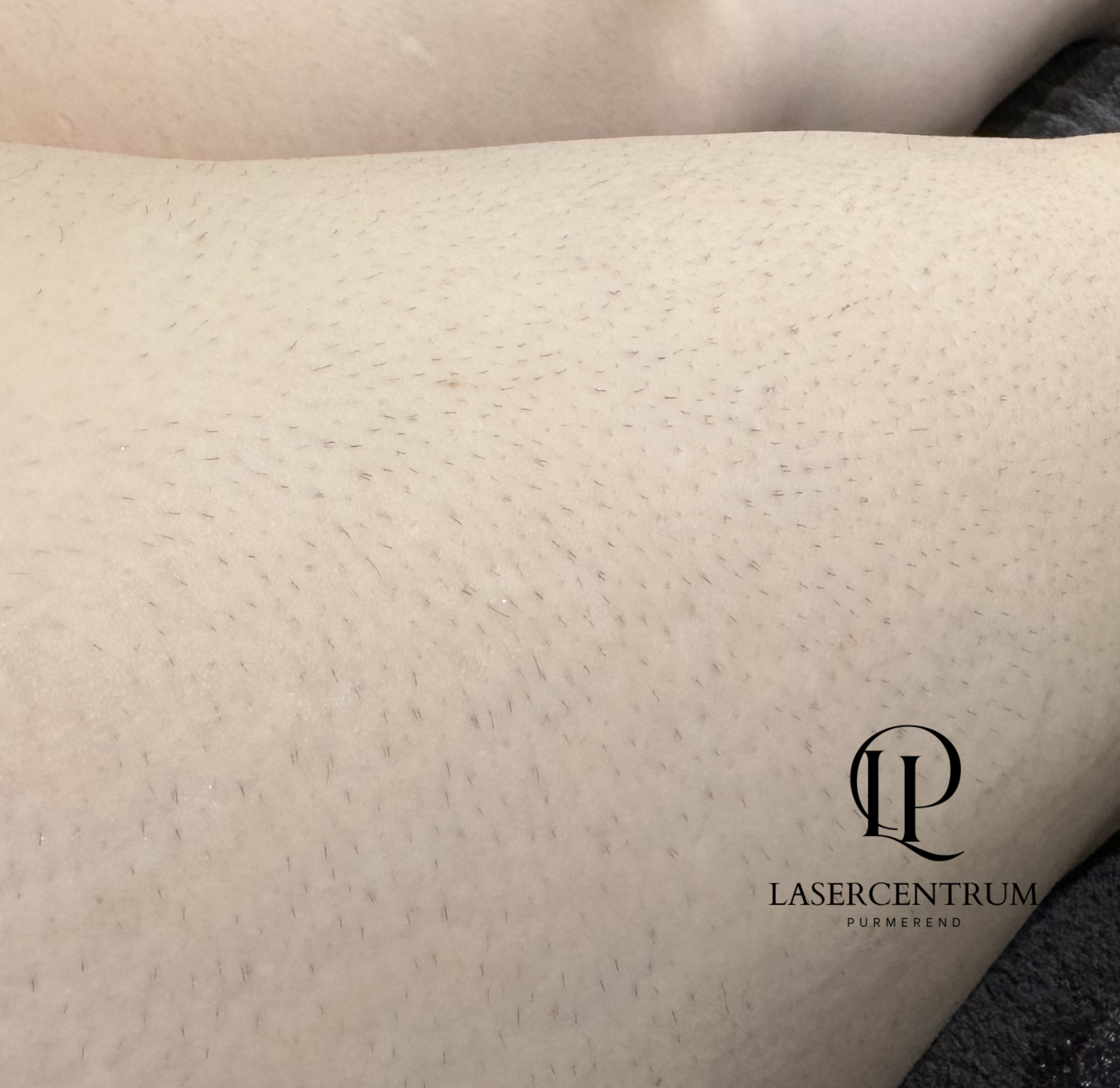 Voor laserontharing bovenbenen in Purmerend