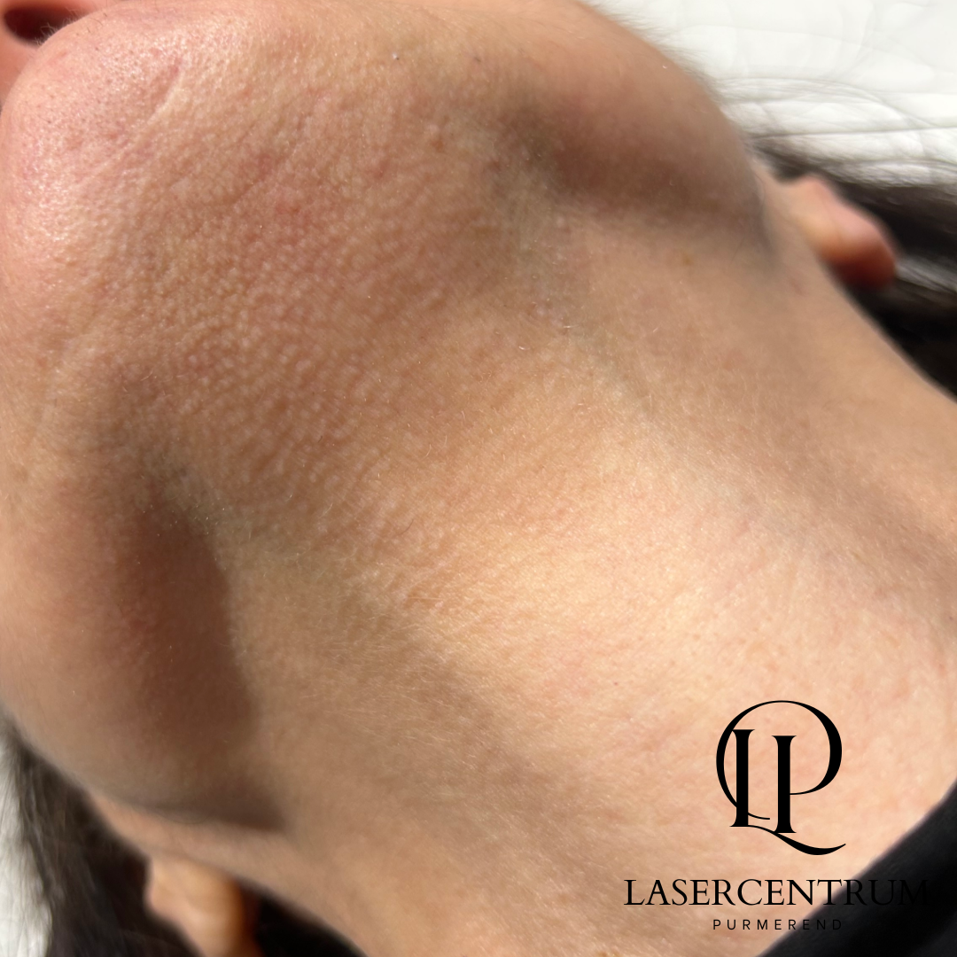 Na behandeling ongewenste haargroei kin