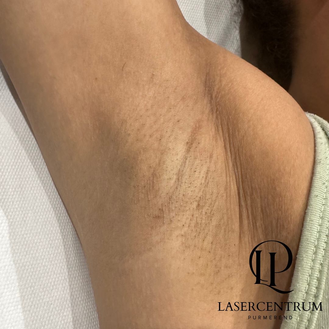 Voor laserontharing oksels in Purmerend