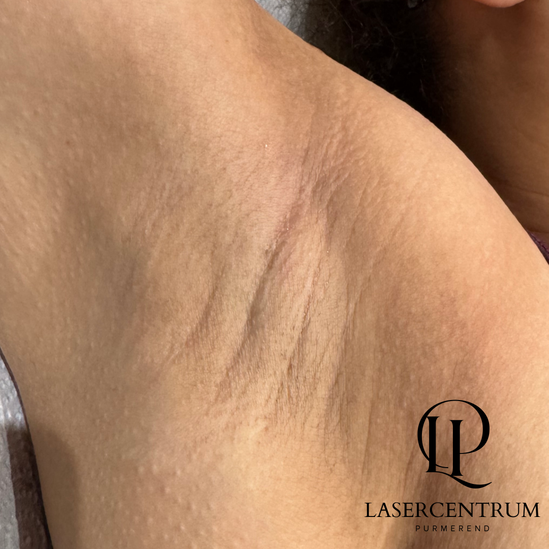 Na laserontharing oksels in Purmerend