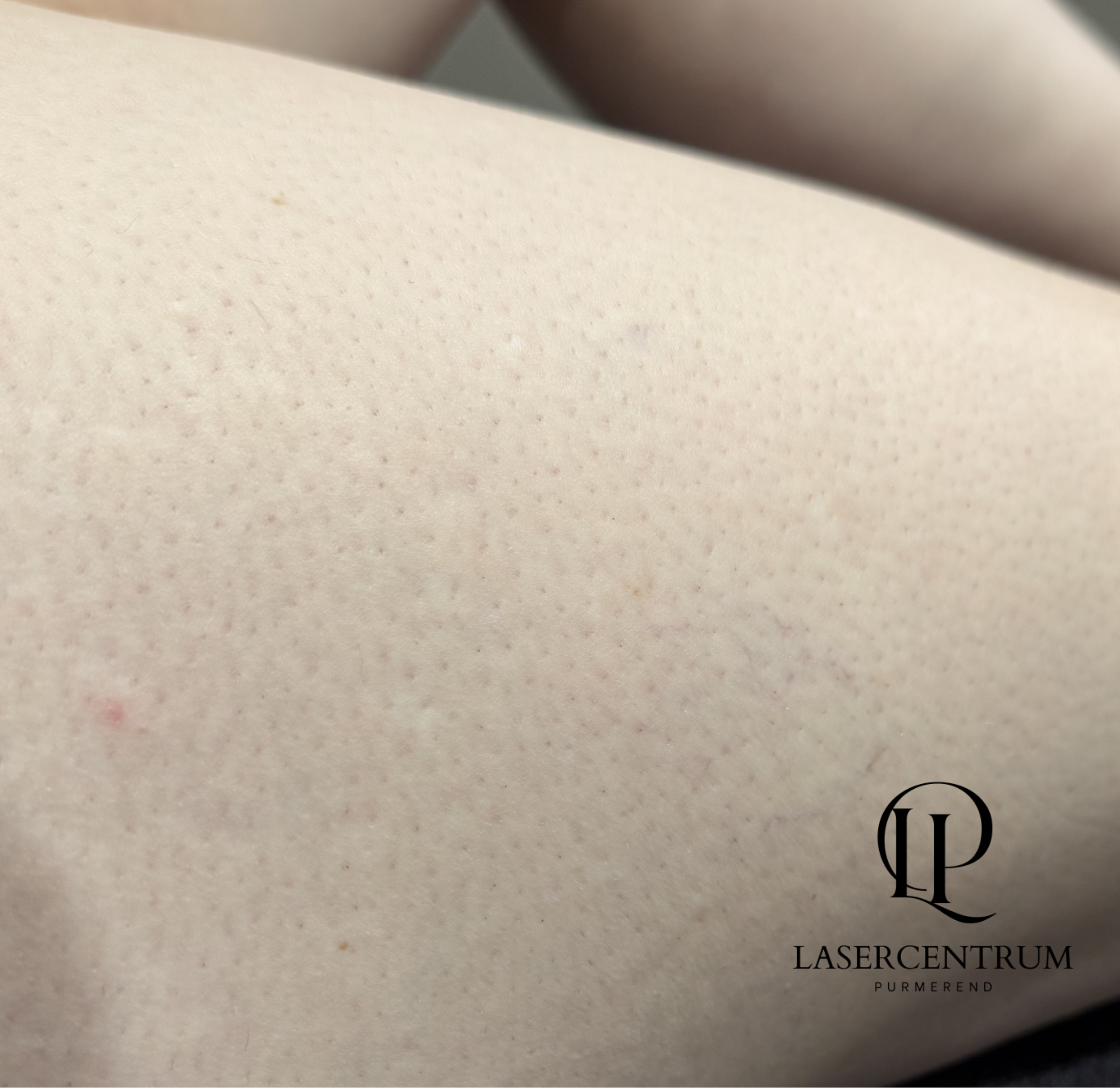 Na laserontharing bovenbenen in Purmerend