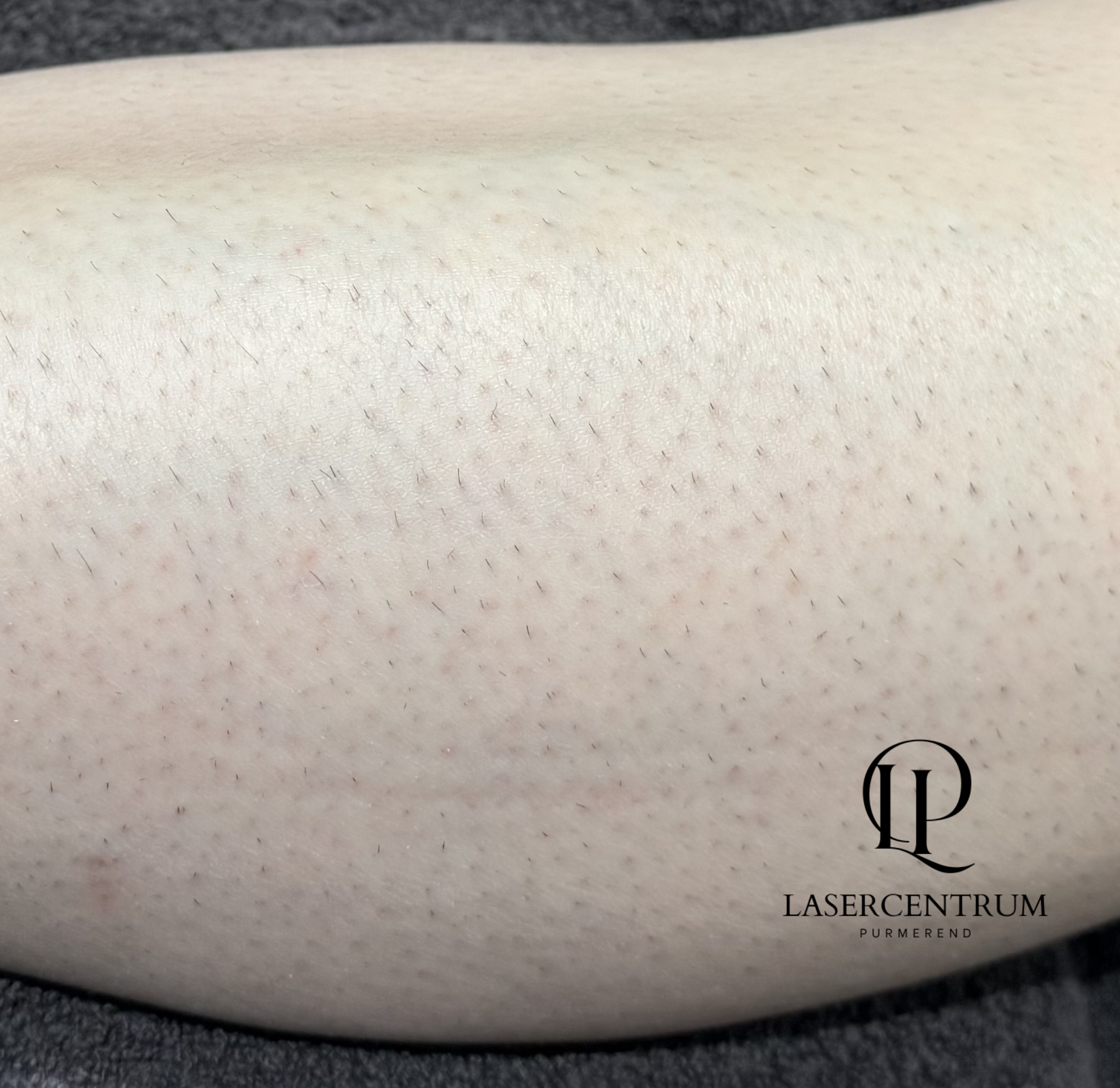 Voor laserontharing onderbenen in Purmerend