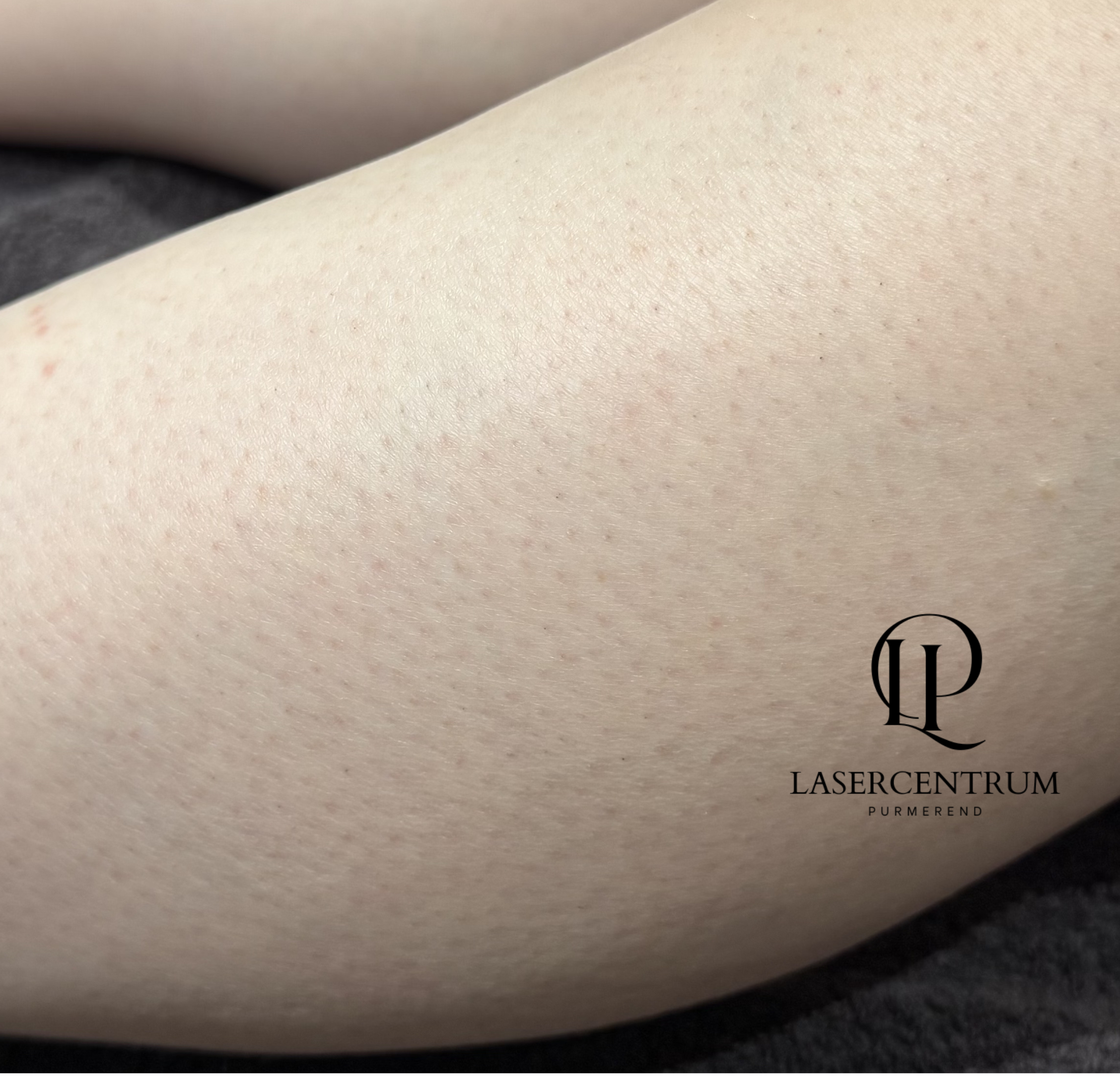 Na laserontharing onderbenen in Purmerend