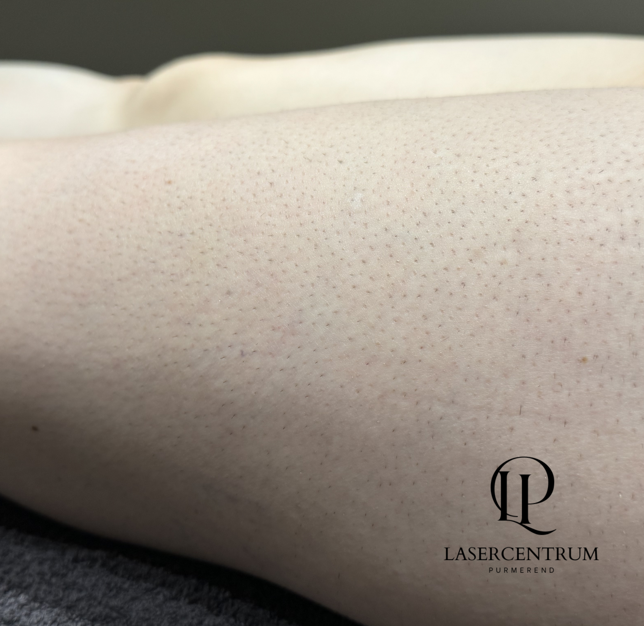 Voor laserontharing bovenbenen met zichtbare stoppels