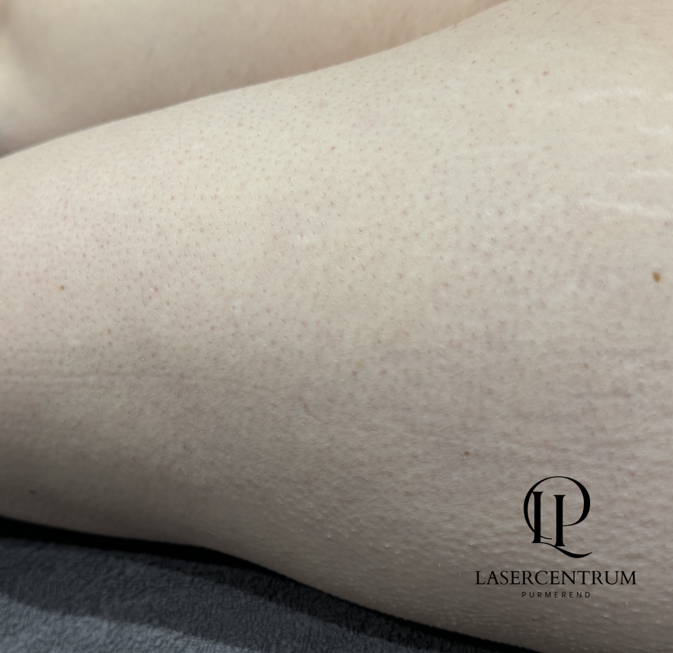 Na laserontharing bovenbenen met gladdere huid