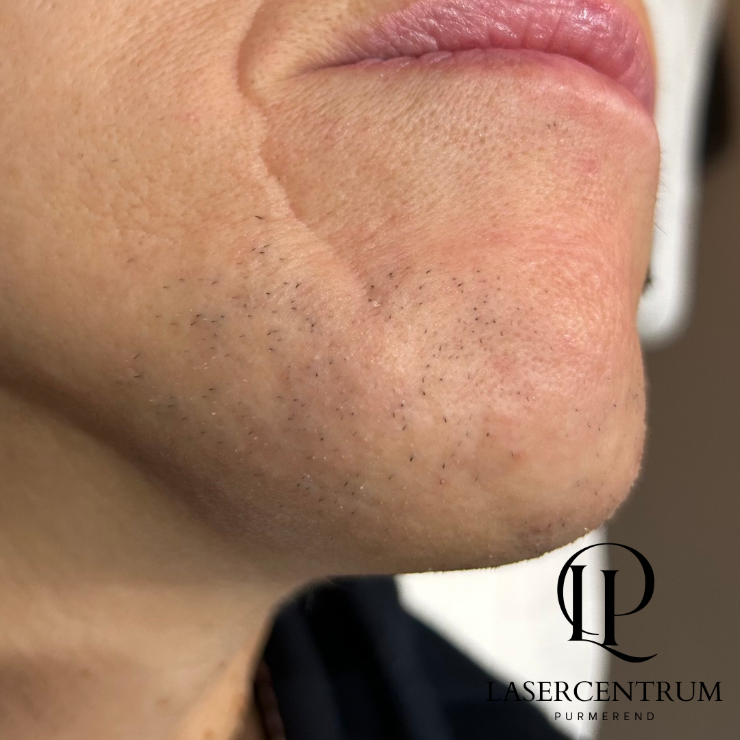 Voor laserontharing kin in Purmerend