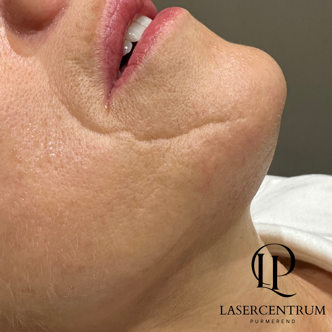 Na laserontharing kin in Purmerend