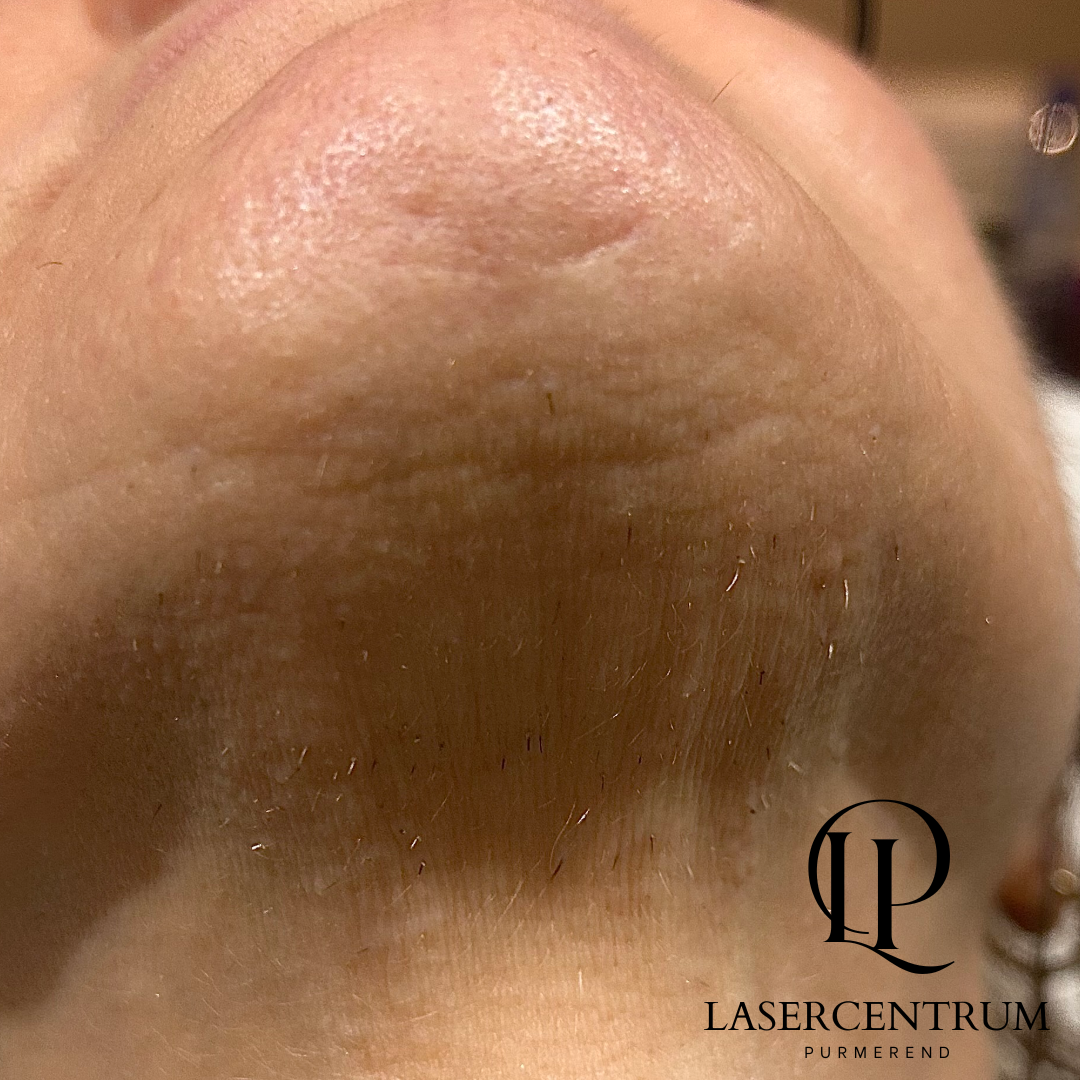 Voor behandeling ongewenste haargroei kin