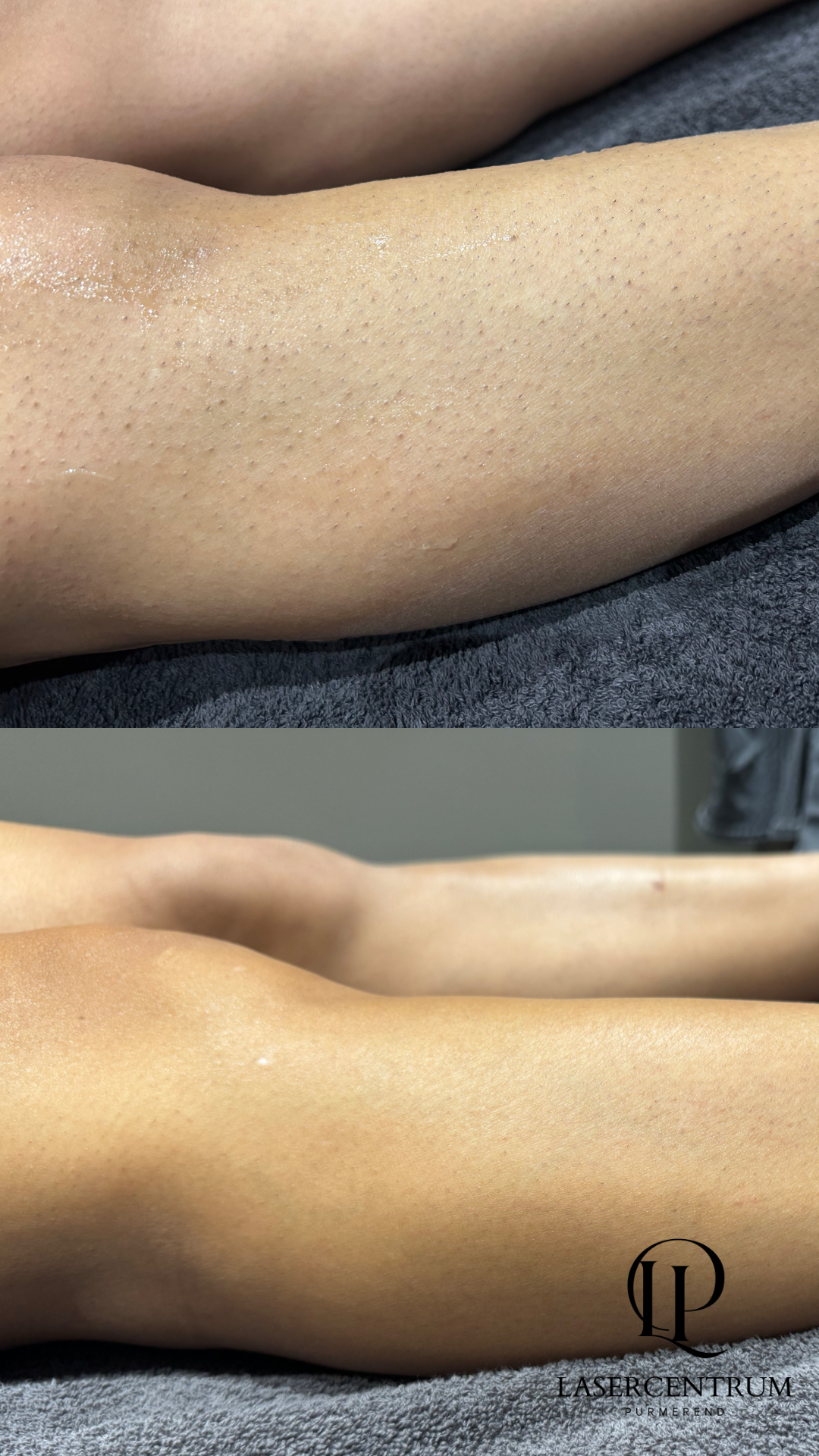 Pigmentvlekken en acne-littekens